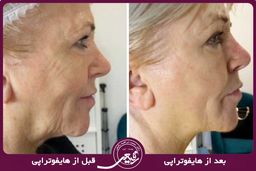 تا 20 سال جوانتر با روش غیر تهاجمی هایفوتراپی صورت
