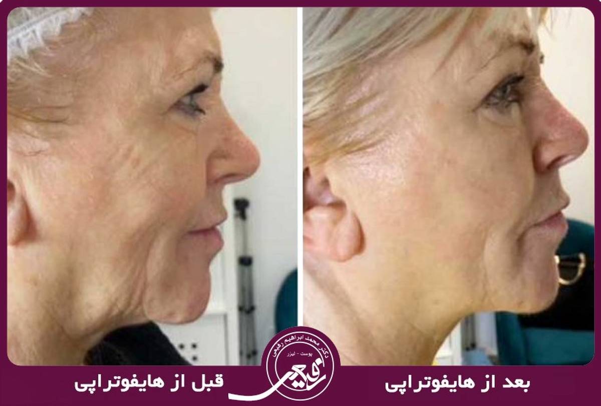 تا 20 سال جوانتر با روش غیر تهاجمی هایفوتراپی صورت