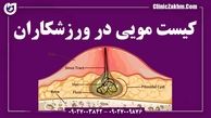 کیست مویی در ورزشکاران: یک مشکل شایع که باید جدی گرفته شود