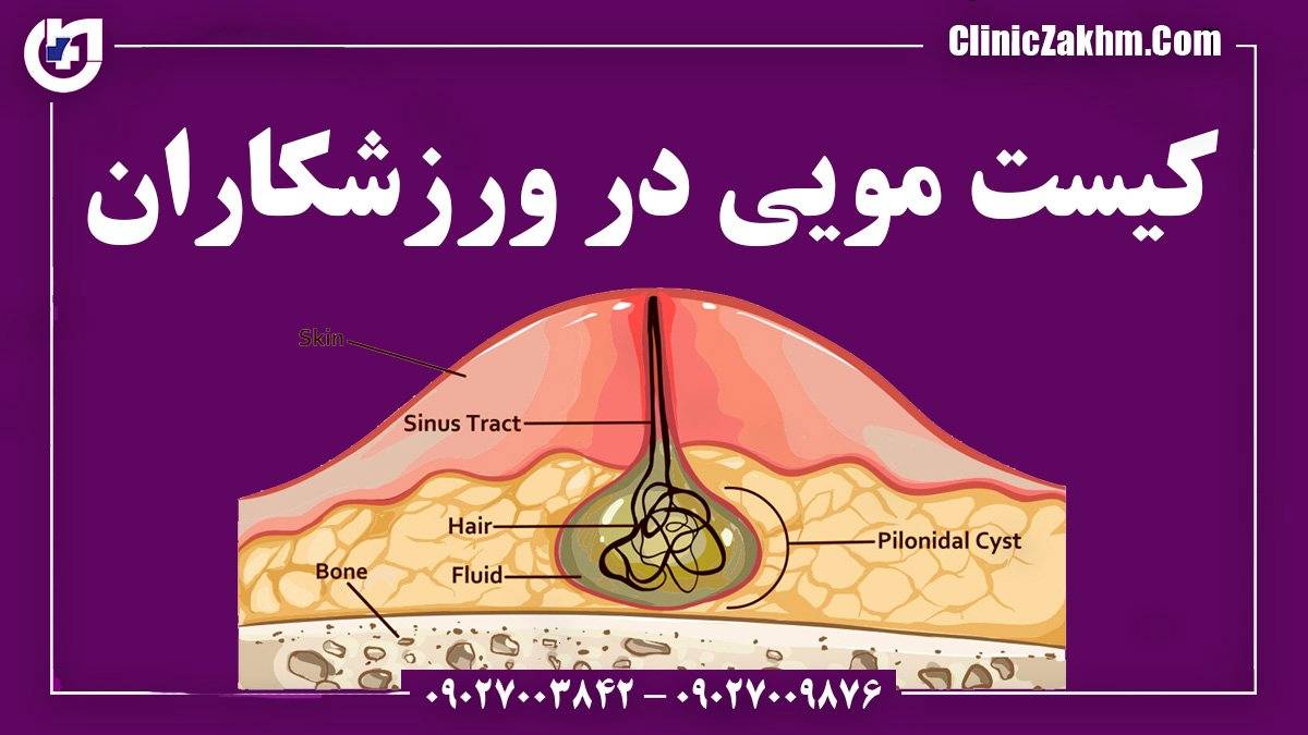 کیست مویی در ورزشکاران: یک مشکل شایع که باید جدی گرفته شود