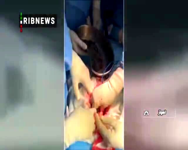 (ویدئو) عجیب از لحظه خروج ۳ کیلو پیچ و مهره از شکم یک بیمار