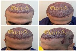 مقایسه کاشت مو به به روش FUT با روش FUE/مزیت ها و معایب