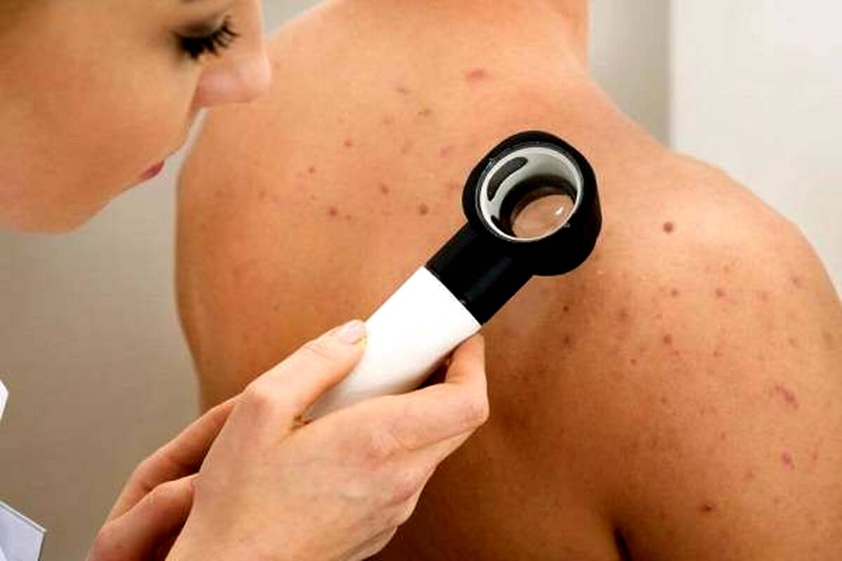راه های پیشگیری از آکنه های پوستی +درمان 