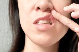 آیا آفت دهان منجر به سرطان می شود ؟