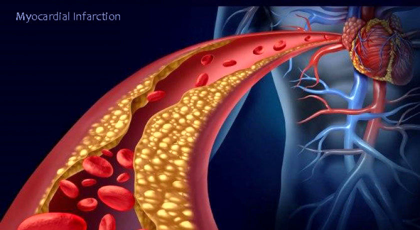 رابطه کمبود خواب و سکته مغزی