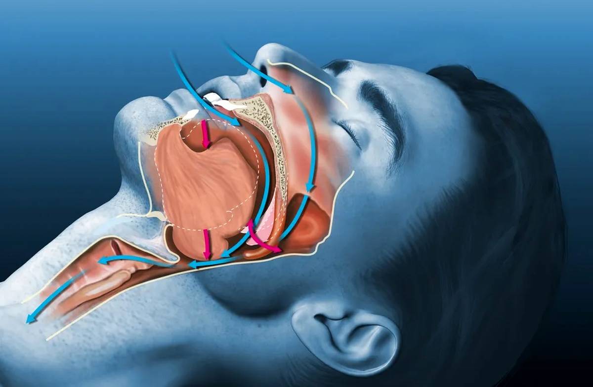 رابطه خروپف کردن و سکته مغزی در حین خواب چیست؟