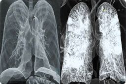 علائم مهم شروع درگیرشدن ریه های مبتلایان کرونا