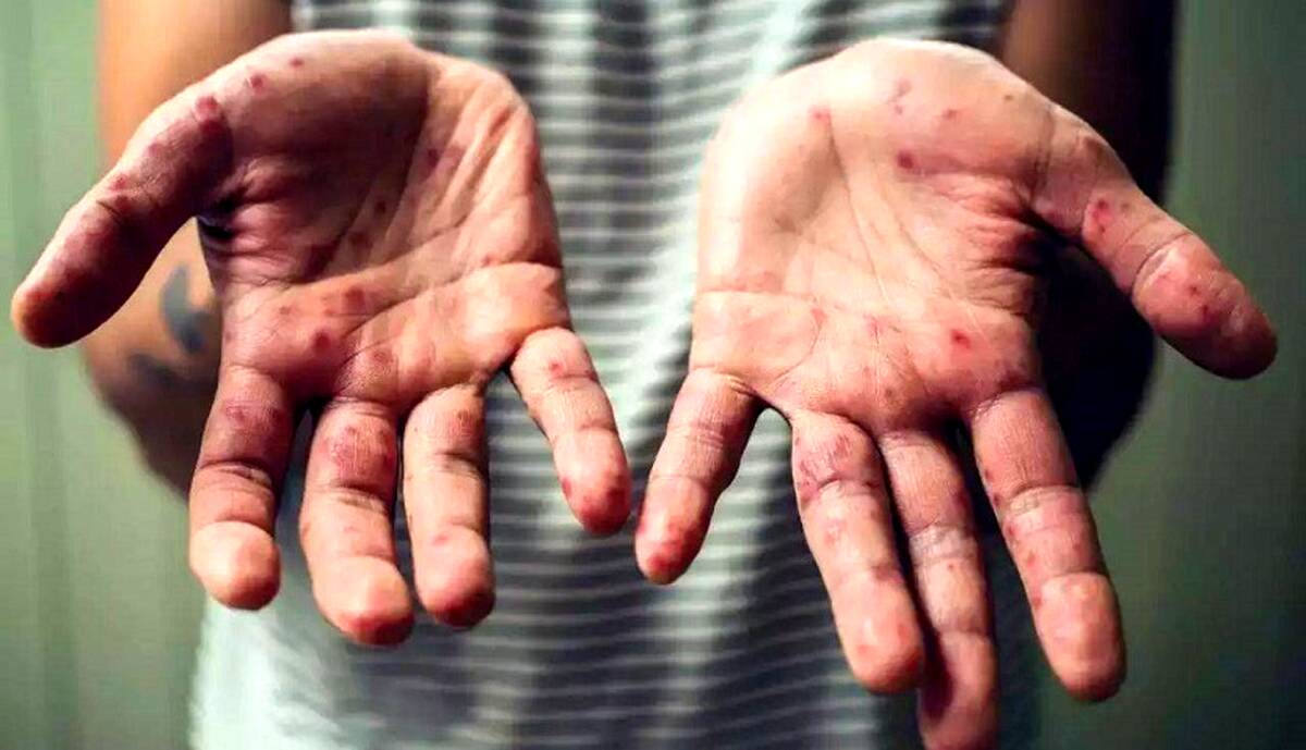 هشدار: طغیان آبله میمون در جهان | آمار مبتلایان آبله میمون