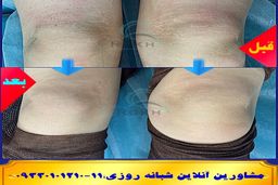 ترک ها پوستی در ورزشکاران و راه درمان آن ؟